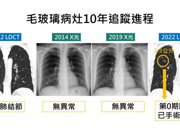 追蹤10年肺結節無異常  低劑量電能斷層揪出1.5公分腫瘤