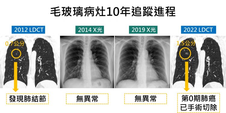 追蹤10年肺結節無異常  低劑量電能斷層揪出1.5公分腫瘤