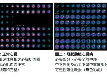 【張婉柔專欄】診斷癌症、心臟病 「核子醫學科」不可或缺
