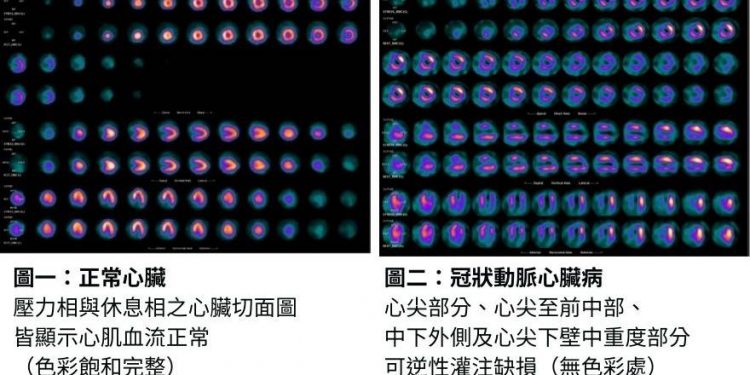 【張婉柔專欄】診斷癌症、心臟病 「核子醫學科」不可或缺