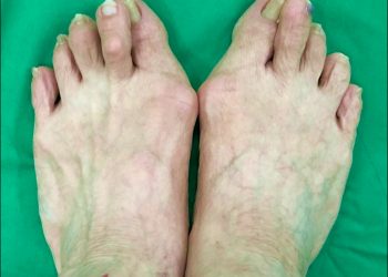 拇趾外翻棄運動10年 手術後重拾慢跑登山