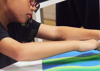 捐出一份愛 守護燒傷顏損兒的未來