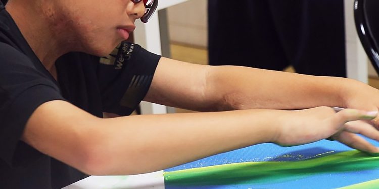 捐出一份愛 守護燒傷顏損兒的未來