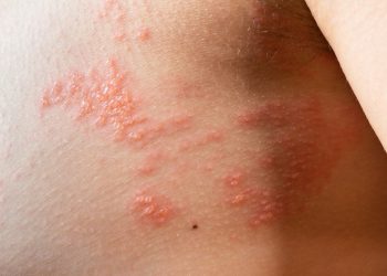 金鐘影后苗可麗遭誤會賣弄性感 竟是「皮蛇」惹的禍 醫喻：積極預防、遠離皮蛇危機!