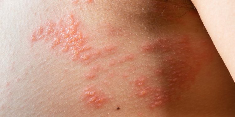 金鐘影后苗可麗遭誤會賣弄性感 竟是「皮蛇」惹的禍 醫喻:積極預防、遠離皮蛇危機!