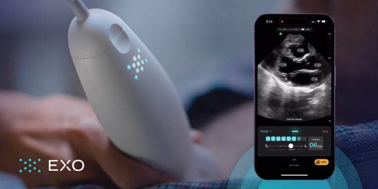 三星創投擬參與Exo新一輪募資 AI掌上超音波裝置引發關注