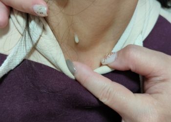 頸部反覆流膿恐藏隱疾 萬芳醫院提醒警覺腮裂囊腫