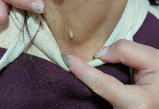 頸部反覆流膿恐藏隱疾 萬芳醫院提醒警覺腮裂囊腫