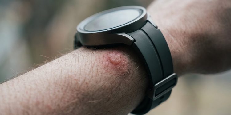 三星 Galaxy Watch 5 Pro 過熱致手腕水泡，專家籲睡前6項檢查